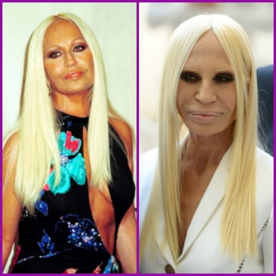 Più passano gli anni più le sue labbra si gonfiano e le sue rughe sparicono: il risultato è un viso completamente levigato e tirato.