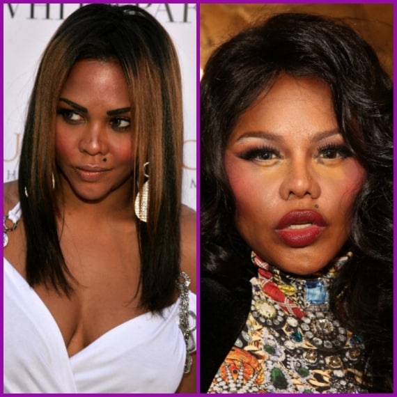 Il suo viso si è fatto sempre più tumefatto, con zigomi in primo piano e labbra decisamente gonfie,