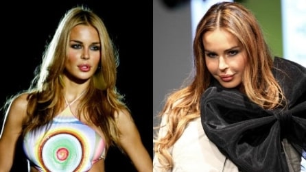 Zigomi da star: prima e dopo il ritocchino