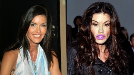 Star e chirurgia: i disastri che cambiano i volti