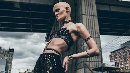 Melanie, la modella senza denti e capelli