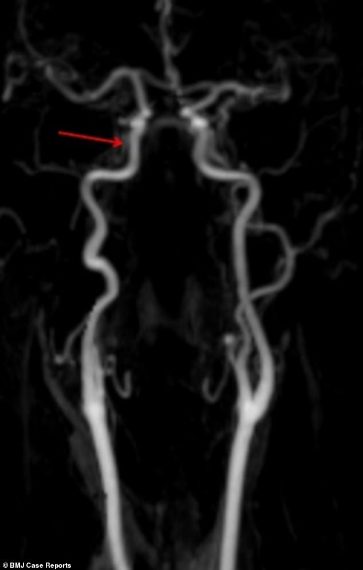 La scansione cerebrale mostra l'arteria guarita