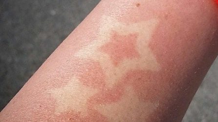 Sunburn tattoo, il (pericoloso) trend che spopola sui social