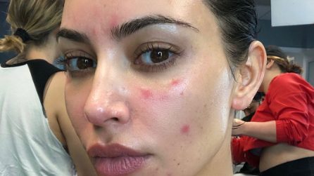 Kim Kardashian mostra i segni della psoriasi