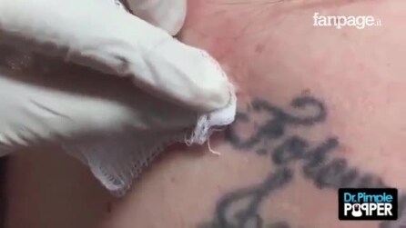 O cisto volta a aparecer no mesmo ponto depois de muito tempo: veja o que a médica faz