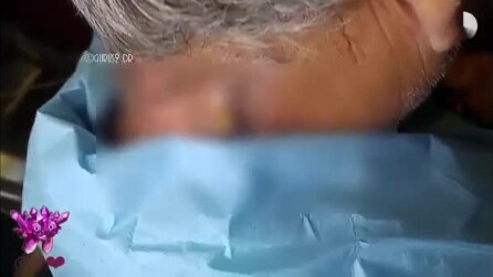 Médico remove cisto sebáceo enorme: algo nojento acontece