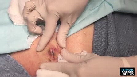 Remoção de cisto: o que sai deixa médico sem palavras