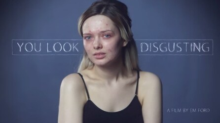 Posta le sue foto sui social senza trucco e con l'acne, ecco le reazioni delle persone