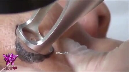 Doutor remove cisto com laser: O resultado é arrepiante