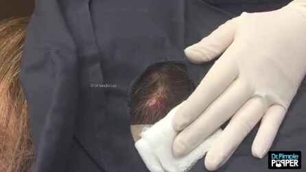 Mulher sente um incômodo na cabeça: veja o que médico tira do cabelo