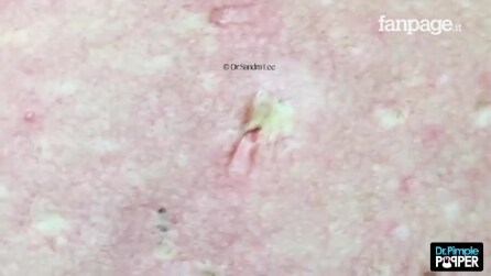 Cravos gigantescos atrás das costas: veja o que acontece ao removê-los