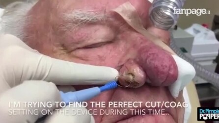 Paciente sofre de rinofima: veja o que acontece quando a médica começa a cirurgia