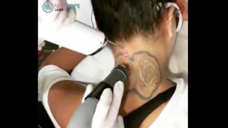 Ha un tatuaggio enorme nascosto sotto i capelli: la rimozione avviene in pochi secondi