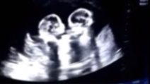 Le gemelline "giocano" nella pancia della mamma: l'ecografia è incredibile